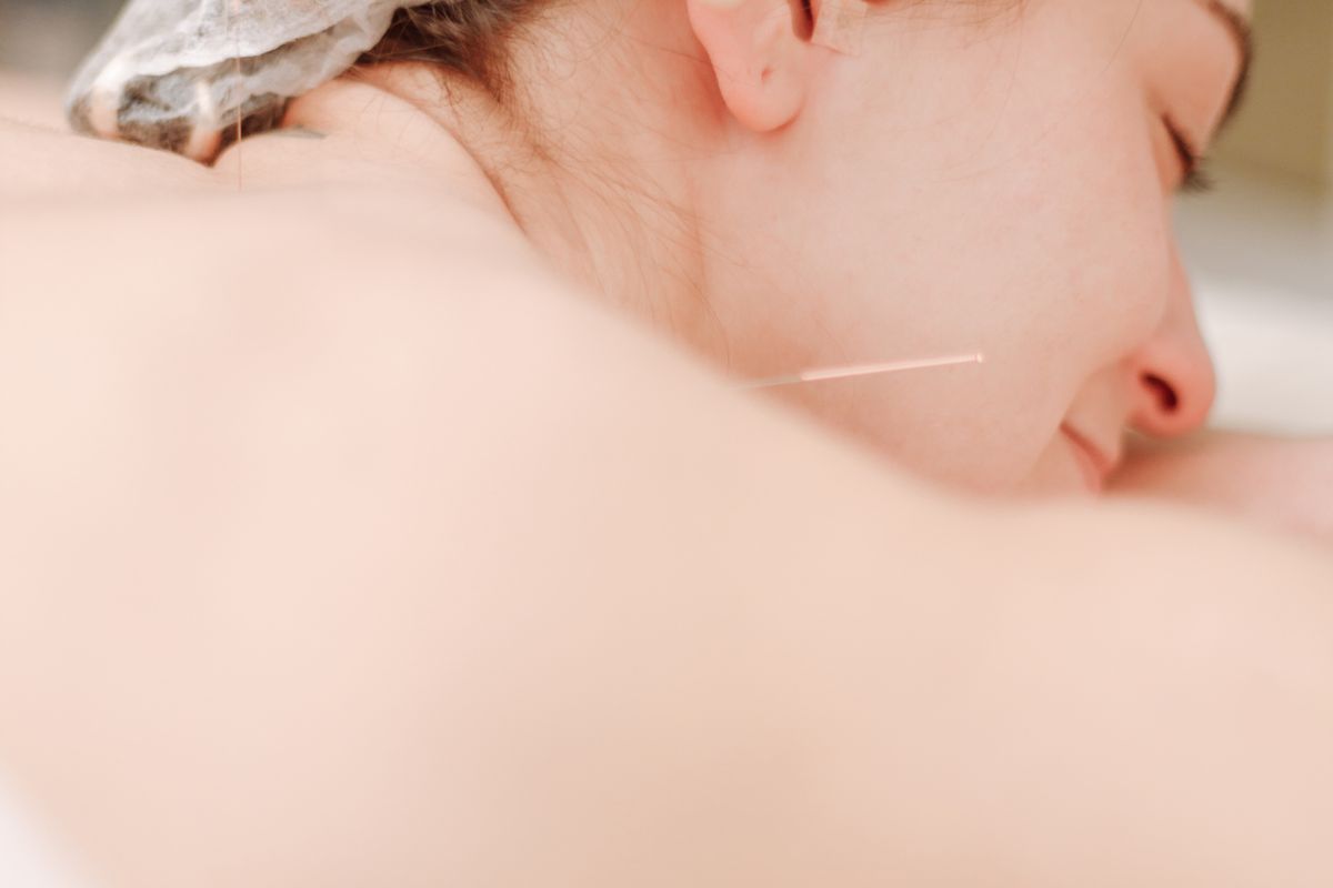 Patient receiving acupuncture treatment in a calm clinical setting