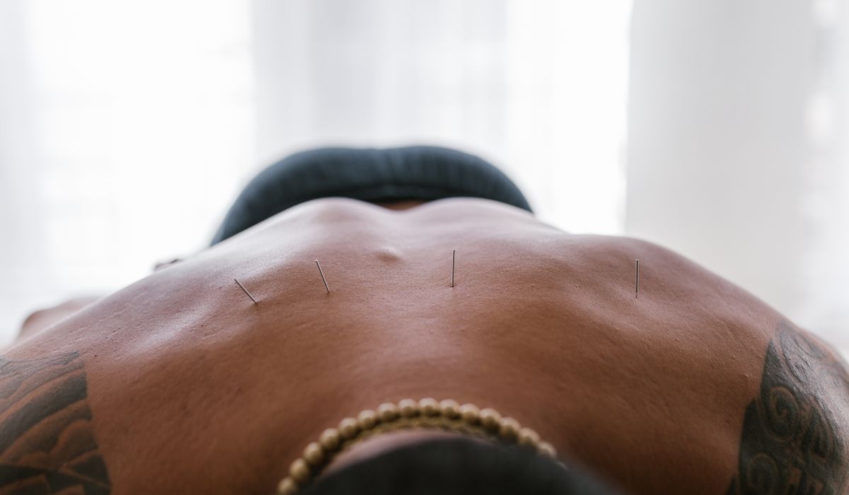 Dry needling filaments placed into trigger points along a patient upper back