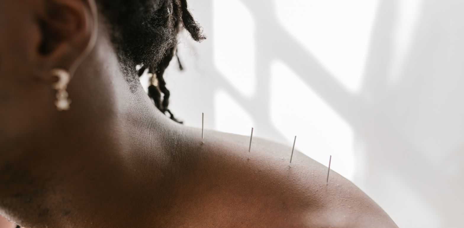 Dry needling filaments placed in the upper trapezius muscle of a patient